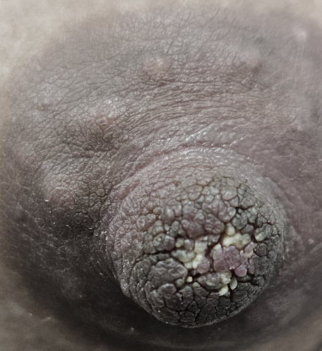 Hyperkeratosis of nipple
